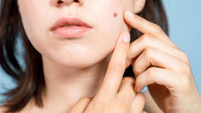 #FORUM Rekomendasi Produk Skincare untuk Mengecilkan Jerawat