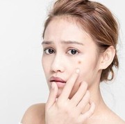 Ladies, Intip Cara Sederhana untuk Mengatasi Jerawat dalam Semalam