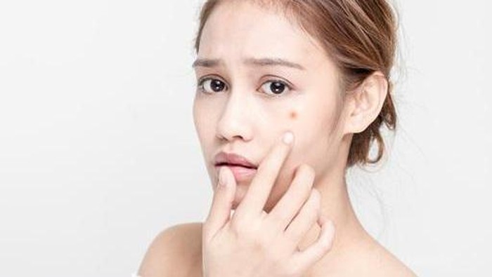Ladies, Intip Cara Sederhana untuk Mengatasi Jerawat dalam Semalam