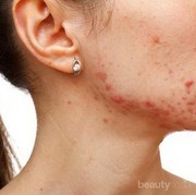 Ada Yang Tau Jerawat Hyperandrogen? Gimana Sih Cara Ngilanginnya?