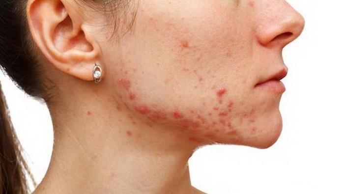 Ada Yang Tau Jerawat Hyperandrogen? Gimana Sih Cara Ngilanginnya? Ada Yang Tau Jerawat Hyperandrogen? Gimana Sih Cara Ngilanginnya?
