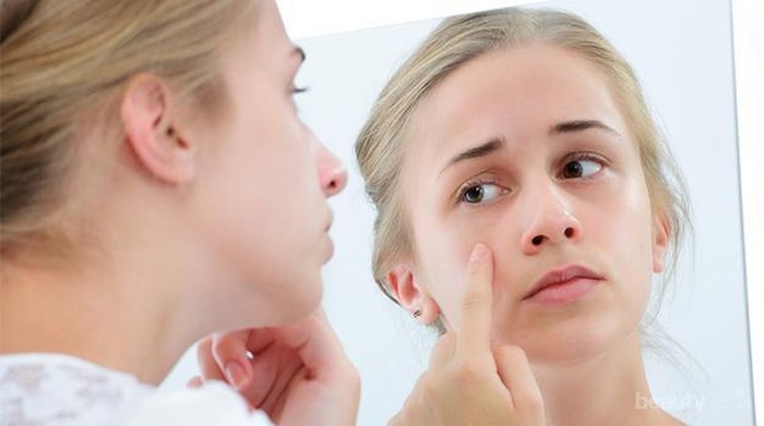 Muncul Jerawat Hormonal Saat Menstruasi? Atasi dengan Cara Ini!
