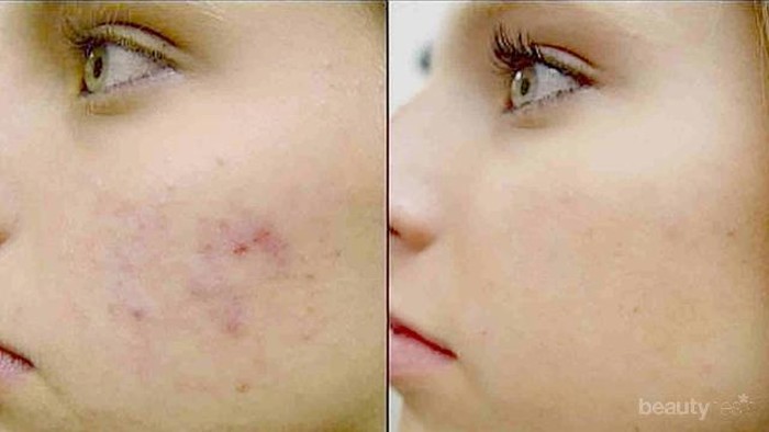 #FORUM Kenapa ya bekas jerawatku selalu muncul di siang hari?