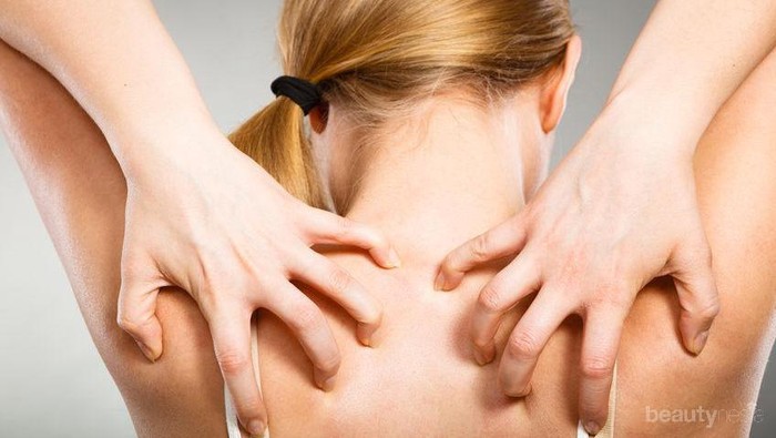 Alami Jerawat di Punggung? Kenali penyebab dan Cara Mengatasinya