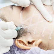 Tergiur Melakukan Tanam Benang? Kamu Wajib Mengetahui Dulu 7 Bahayanya Ini, Ladies!