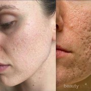 5 Treatment untuk Menghilangkan Bopeng Bekas Jerawat
