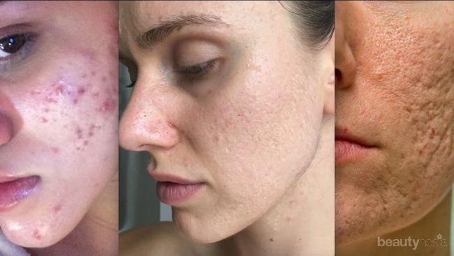 5 Treatment untuk Menghilangkan Bopeng Bekas Jerawat