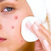 #FORUM Kenapa Wajah Aku Mudah Berjerawat ya?