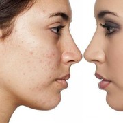 Bruntusan Bikin Bete? Coba Cari Tahu Dulu Penyebabnya