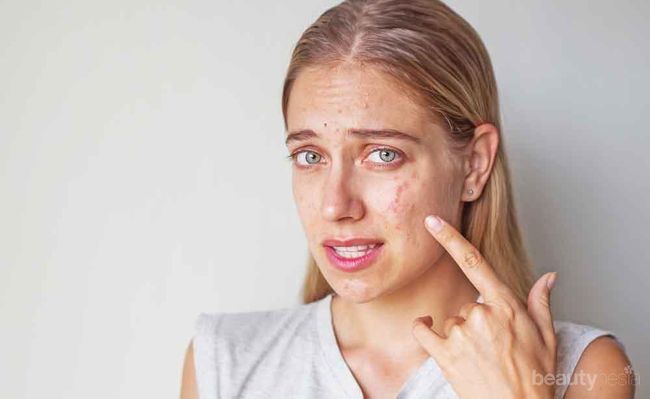 #FORUM Cara mengatasi jerawat di wajah yang merah dan  