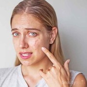 #FORUM Cara mengatasi jerawat di wajah yang merah dan meradang gimana?