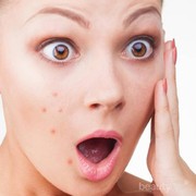 #FORUM Bolehkah Memencet Jerawat di Pipi?