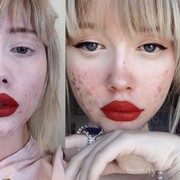 Dear, gimana ya cara menghilangkan bekas jerawat yang sudah menahun? Harus pakai produk apa?