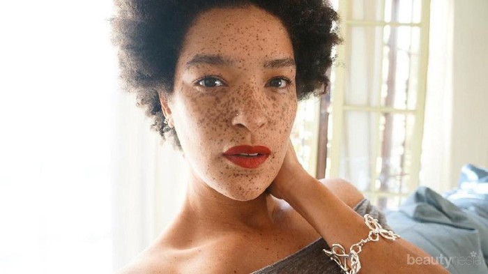 So Inspiring! Deretan Influencer Ini Berani Tampil Percaya Diri dengan Bintik Hitam di Wajah