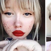 Apa Produk Pembasmi Jerawat Andalanmu Ladies?? Cerita Disini Yuk!