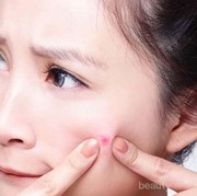 Bisa Sampai Demam! Jangan Pernah Pencet Jerawat Pada Bagian Ini Ya!
