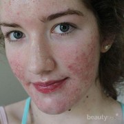 Waduh! Makanan Berikut Ternyata Bikin Jerawatmu Makin Parah Lho!