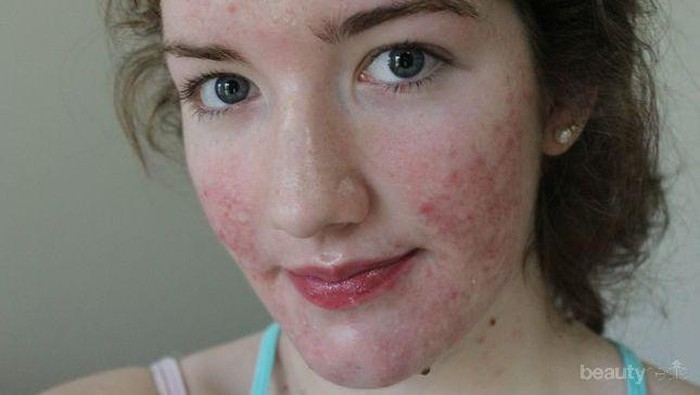 Waduh! Makanan Berikut Ternyata Bikin Jerawatmu Makin Parah Lho!