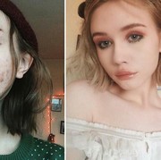 Bete sama Jerawat dan Kulit Berminyak? Cobain Deretan Pelembap Ini Aja Ladies!