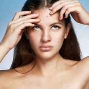 Ternyata, Begini Lho Cara Menghilangkan Jerawat di Dahi Kamu, Ladies!