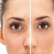 Noda hitam bekas jerawat