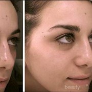 Ladies, 4 Bahan Alami Ini Bisa Hilangkan Noda Hitam di Wajah Sampai Tuntas!