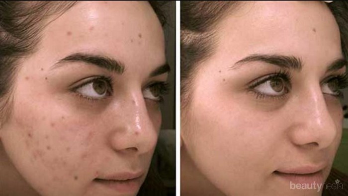 Ladies, 4 Bahan Alami Ini Bisa Hilangkan Noda Hitam di Wajah Sampai Tuntas!