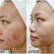 #FORUM Bekas Jerawat yang Menghitam di Wajah Apakah Bisa Dihilangkan??