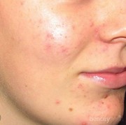 3 Produk Dasar yang Perlu Kamu Coba dalam Skincare Routine Kulit Berjerawat