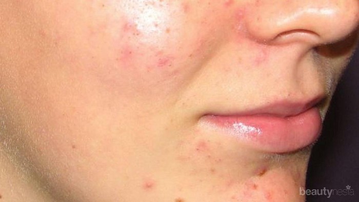 3 Produk Dasar yang Perlu Kamu Coba dalam Skincare Routine Kulit Berjerawat