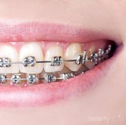 #FORUM Gimana Proses Pemakaian Behel? Sakit gak?