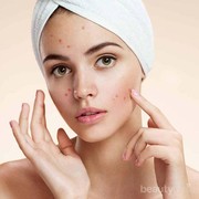 Ingin Punya Wajah Mulus Tanpa Jerawat? Jauhi Makanan Ini Ladies!