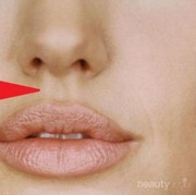 #FORUM Apa Penyebab Jerawat Bawah Hidung?