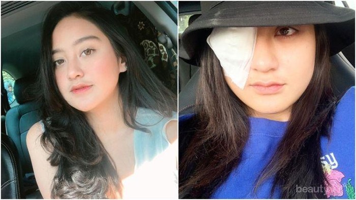 Belajar dari Salshabilla Adriani, Ini Tips Aman Menggunakan Softlens Ladies!