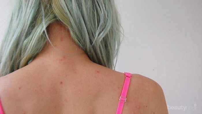 Ternyata Ini yang Menjadi Penyebab dan Cara Mengatasi Jerawat Punggung Paling Ampuh!