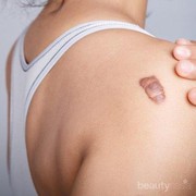 Sebagai Alternatif Penyembuhan, Gunakan 4 Jenis Perawatan Keloid Ini