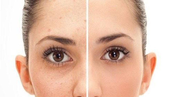 Tanpa Laser, Begini Cara Hilangkan Flek Hitam dengan Bahan Alami