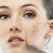 Cara Alami Basmi Bekas Jerawat