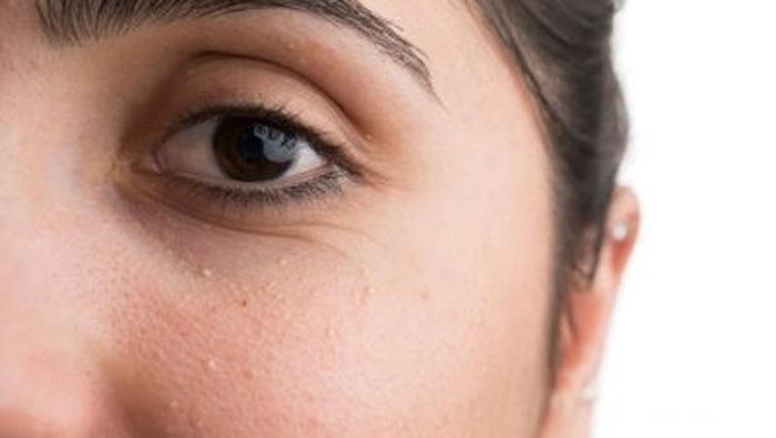 [FORUM] Cara menghilangkan beruntusan akibat makeup gimana sih...