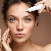 Acne Porne! Ini 5 Rekomendasi Serum untuk Menghilangkan Jerawat