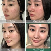 Tak Perlu Facial Mahal, Essence Korea Ini Ampuh Atasi Jerawat dan Bekasnya
