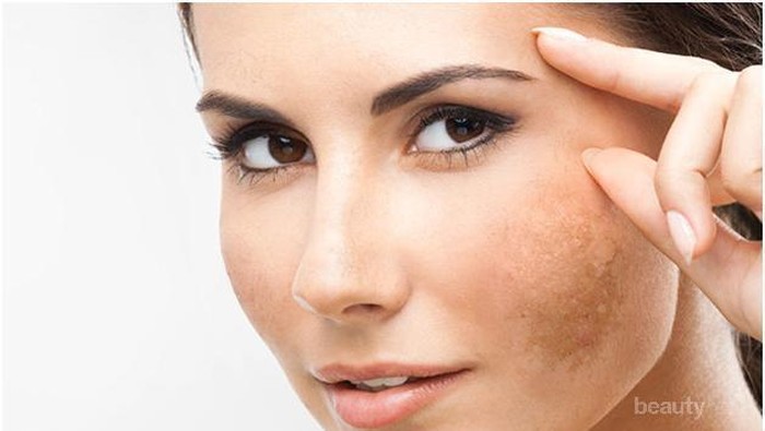 Kenali Penyebab Munculnya Flek Hitam di Wajah, Bukan Cuma Sinar Matahari Lho