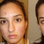 Cleansing Hingga Sunscreen, Ini Rekomendasi Skincare Ampuh untuk Menghilangkan Bruntusan
