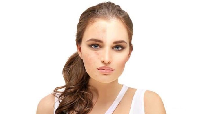 6 Penyebab Munculnya Flek Hitam yang Tidak Boleh Kamu Sepelekan