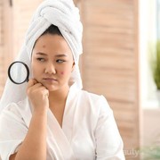 [FORUM] Kenapa Sih Jerawat dan Komedo Gak Ilang-Ilang? Hiks..