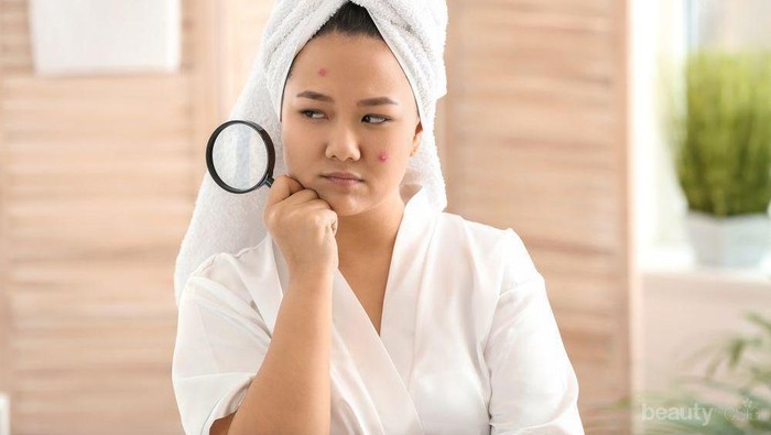 [FORUM] Kenapa Sih Jerawat dan Komedo Gak Ilang-Ilang? Hiks..