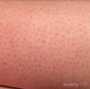 Bye-Bye Kaki Stoberi, Ini Tips Mengatasinya dari Dermatologis