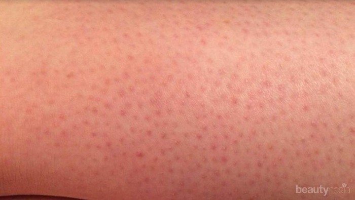 Bye-Bye Kaki Stoberi, Ini Tips Mengatasinya dari Dermatologis