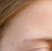 [FORUM] Gimana cara ngatasin bruntusan di area hidung?