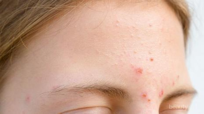 [FORUM] Gimana cara ngatasin bruntusan di area hidung?